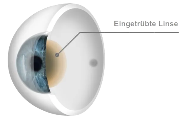 Grauer Star eingetrübte Linse