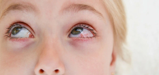 Frau mit geröteten Augen
