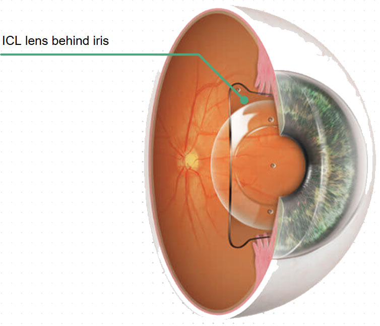 Querschnitt des Auges mit der ICL Linse hinter der Iris