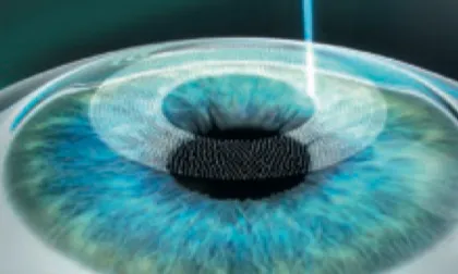  Die Flap Bildung als erster Schritt beim Augenlasern mit LASIK