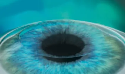 Zurücklegen des Flaps beim Augenlasern mit LASIK in Frankfurt