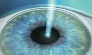 Modellieren der Hornhaut beim Augenlasern mit LASIk in Frankfurt