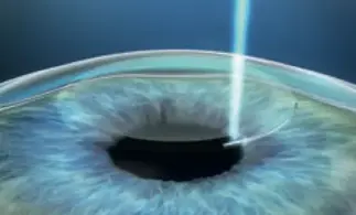  Die Lentikel Bildung als erster Schritt beim Augenlasern mit SMILE PRO