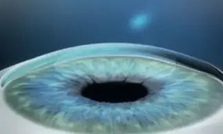 Korrektur des Sehfehlers beim Augenlasern mit SMILE PRO in Frankfurt