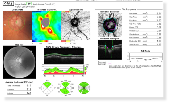 3D Scan Bild dank Modernster Glaukom Diagnostik für Ihre Augen.