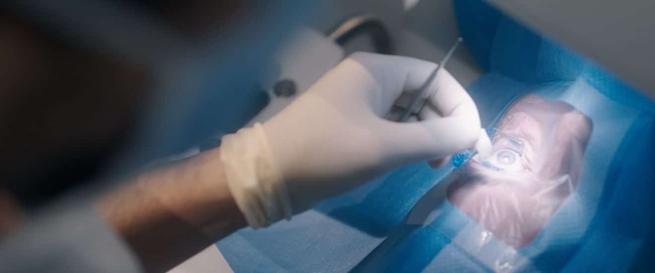 Welche Laserverfahren gibt es und welches Verfahren passt zu mir?