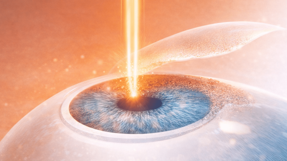 Augenarzt & Augenlasern Frankfurt dr.vision PRK Verfahren Oberflächen-Behandlung