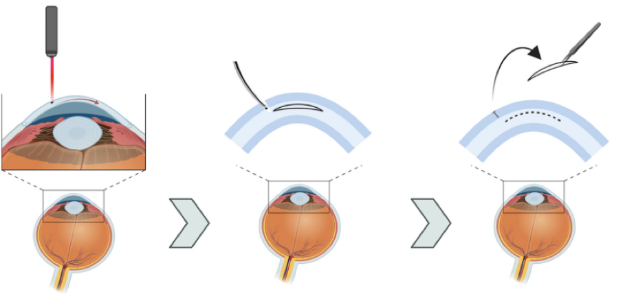 Augenarzt & Augenlasern Frankfurt dr.vision Augenarzt & Augenlasern Frankfurt dr.vision